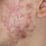 Active Acne