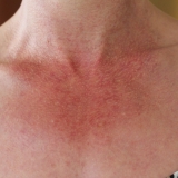 Redness and Flushing