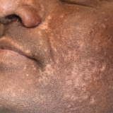 Pigmentation