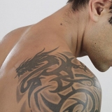 Tattoo Removal